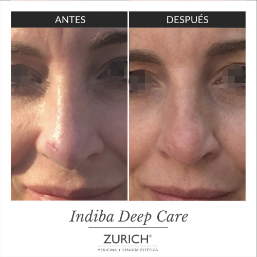 Antes y despu�s �Eliminacion cicatriz